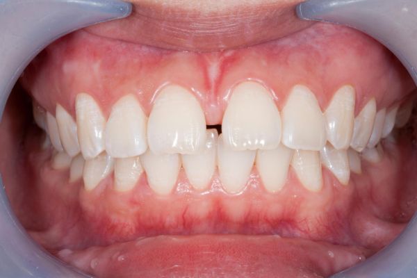 persons mouth showing gaps in the front teeth