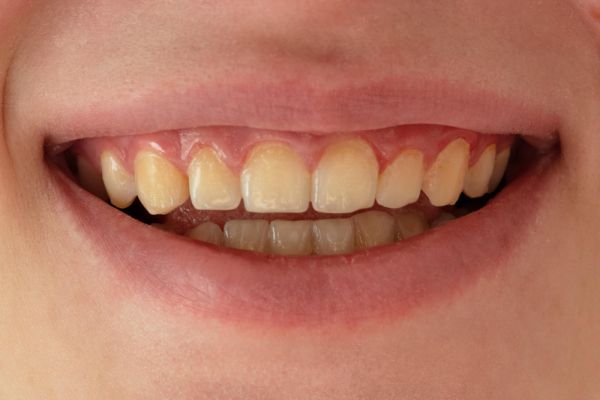 womans mouth showing discoloured teeth