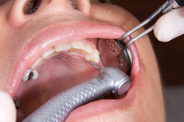 A woman showing her teeth in a smile, with hidden lingual braces not visible in the image.