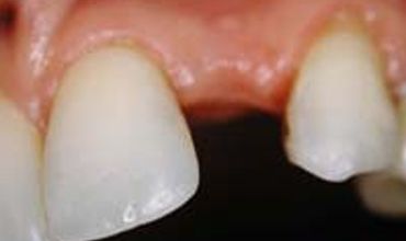 missing tooth