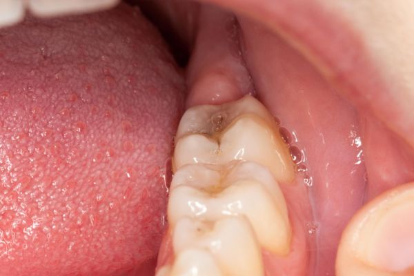 A man wearing metal braces, highlighting his dental treatment.