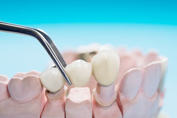 A man wearing metal braces, highlighting his dental treatment.
