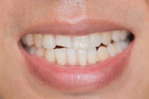 persons teeth, with a chipped front tooth
