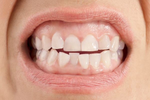person's teethe showing the lower jaw with crooked teeth